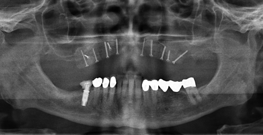 Abb. 12: Radiologische Kontrollaufnahme nach Fixierung der allogenen Knochenblöcke im Oberkiefer.