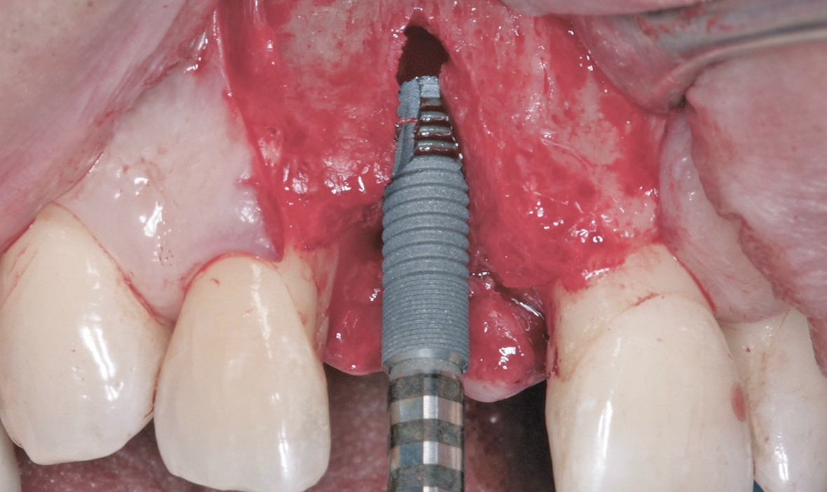Abb. 8: Insertion eines Astra EV Implantats.
