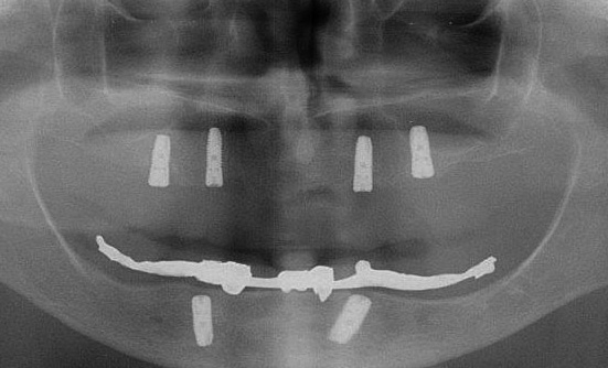 Abb. 54: Drei Monate nach der Implantation von vier Oberkiefer-Implantaten erfolgte die Insertion von zwei Implantaten im Unterkiefer. Im Oberkiefer sind die bereits gut osseointegrierten Implantate ebenfalls zu erkennen.