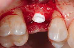 Abb. 9: Implantat leicht supracrestal in situ.