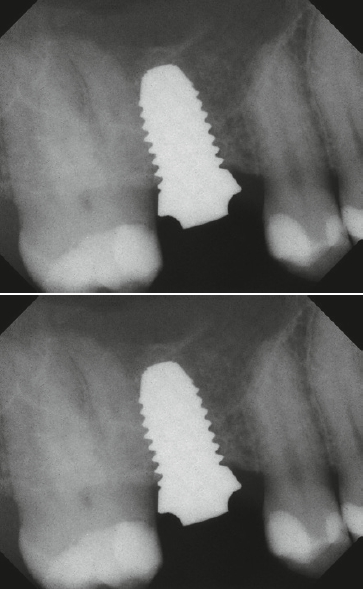 Abb. 11 und 12: Beeindruckendes Knochenwachstum nach direktem, internen Sinuslift (nur CollaWin! und Blut als KEM) an Zirkon-Implantaten bei einem zweiteiligen BioWin! Zirkon-Implantat, zwei Jahre post OP.