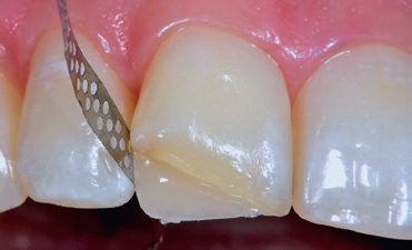 Abb. 8: Sollte der Kontaktpunktbereich verklebt sein, kann zur Öffnung des Interdentalraumes ein einseitig diamantierter Streifen (perforierter Streifen, blau [Edenta, AU/CH]) verwendet werden. Die unbelegte Seite weist dann nach mesial, um die Inhibitionsschicht nicht zu beschädigen, da noch weiteres Komposit aufgetragen werden soll.