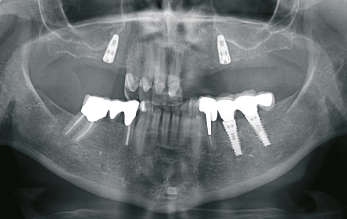 Abb. 8: Orthopantomografie zur postoperativen Kontrolle der Implantatpositionen.