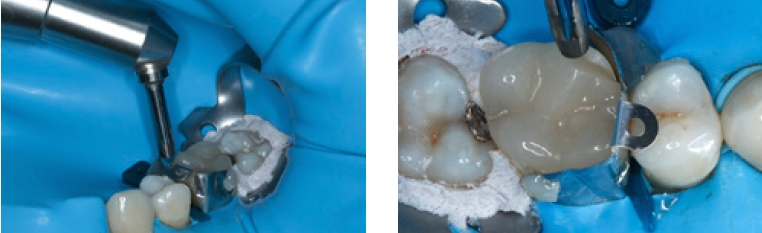 Abb. 8 und 9: Die Frakturfläche der Keramikteilkrone wird mit einem intraoralen Sandstrahler tribochemisch vorbehandelt.