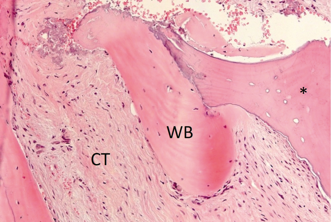 Abb. 10: Die histologische Aufnahme zeigt neu gebildeten Gefl echtknochen (WB) in engem Kontakt mit dem Allograftmaterial (*) und umgeben von Bindegewebe (CT).