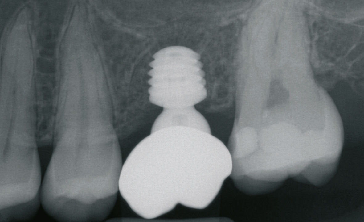 Abb. 8: Röntgenkontrolle der Abutmentkrone mit Knochenapposition auf der Implantatschulter.