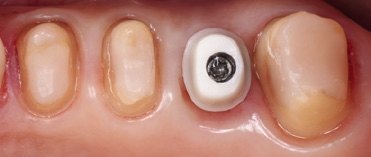 Abb. 4a: Präparationen für monolithische Seitenzahnkronen aus Lithiumdisilikatkeramik (IPS e.max Press). Das Implantatabutment 26 aus Zirkoniumoxidkeramik wurde auf einer Titanbasis verklebt (Hybridabutment), anschließend intraoral verschraubt und zur Herstellung der Kronen zusammen mit den natürlichen Pfeilern 24, 25 und 27 abgeformt.