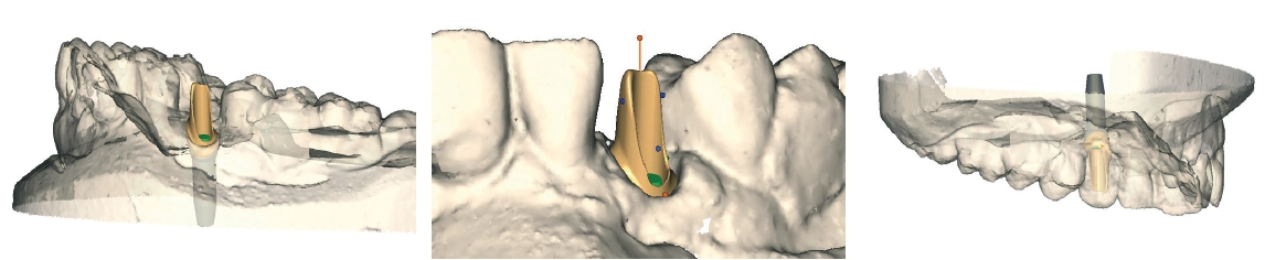 Abb. 8a –c: Konstruktion des Abutments regio 13 in der Atlantis-VAD-Software. Durch das Einblenden des Wax-ups kann die ideale verkleinerte anatomische Zahnform konstruiert werden.