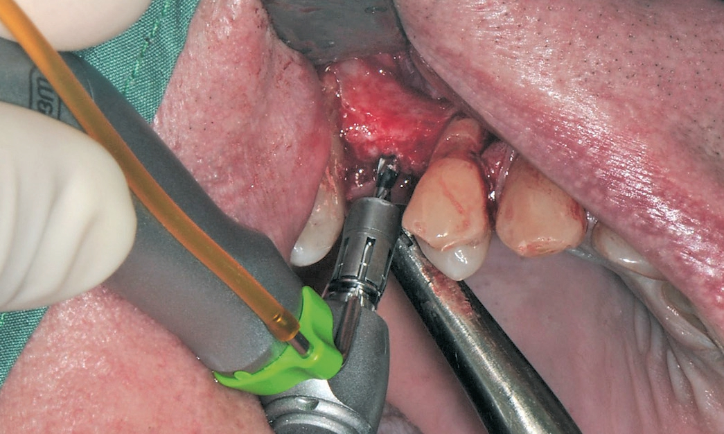 Abb. 7: Aufbereiten des Implantatbettes gemäß SIC-Protokoll.
