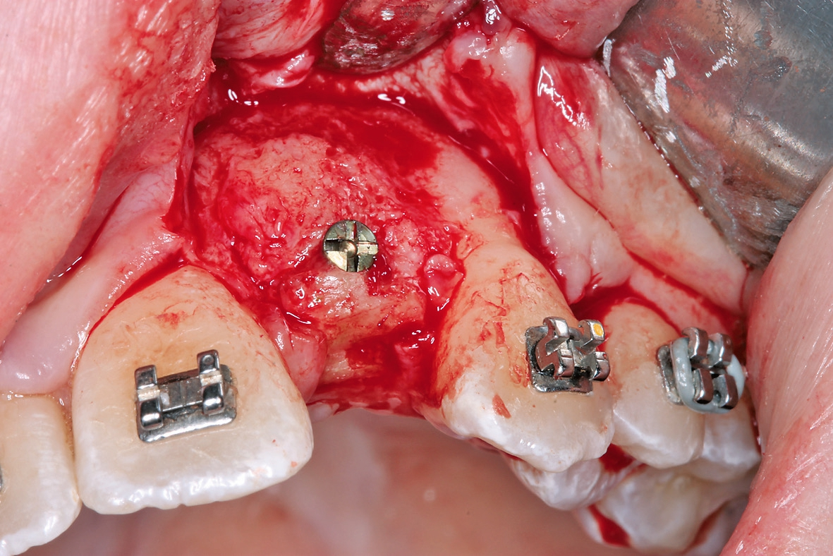 Abb. 9: Insertion der Implantate nach viereinhalbmonatiger Einheilung der allogenen Knochenblöcke.