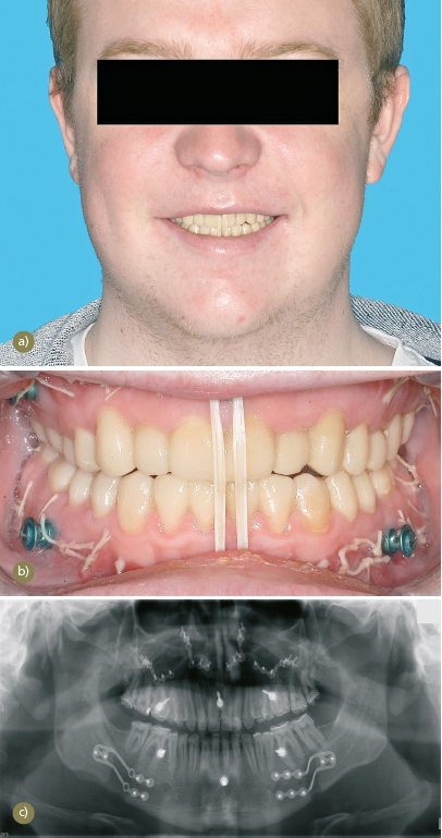 Abb. 8: Zustand nach bimaxillärer Umstellungsosteotomie. a) Frontansicht (leicht lächelnd) mit intermaxillärer Verschnürung. b) Intraorale Ansicht mit intermaxillärer Verschnürung mittels Gummizug. c) OPG mit sichtbaren Osteosyntheseplatten im Ober- und Unterkiefer.