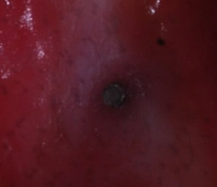 Abb. 12: Klinische Situation nach Entfernen des Abutments und der Schraube.