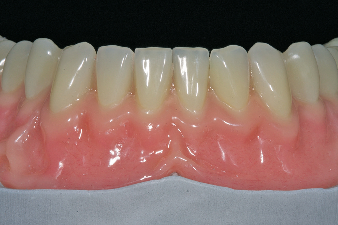 Abb. 8: Unterkiefer-Totalprothese aus frontaler Sicht – Frontzahnästhetik mit Alveolen-und Lippenbandgestaltung.