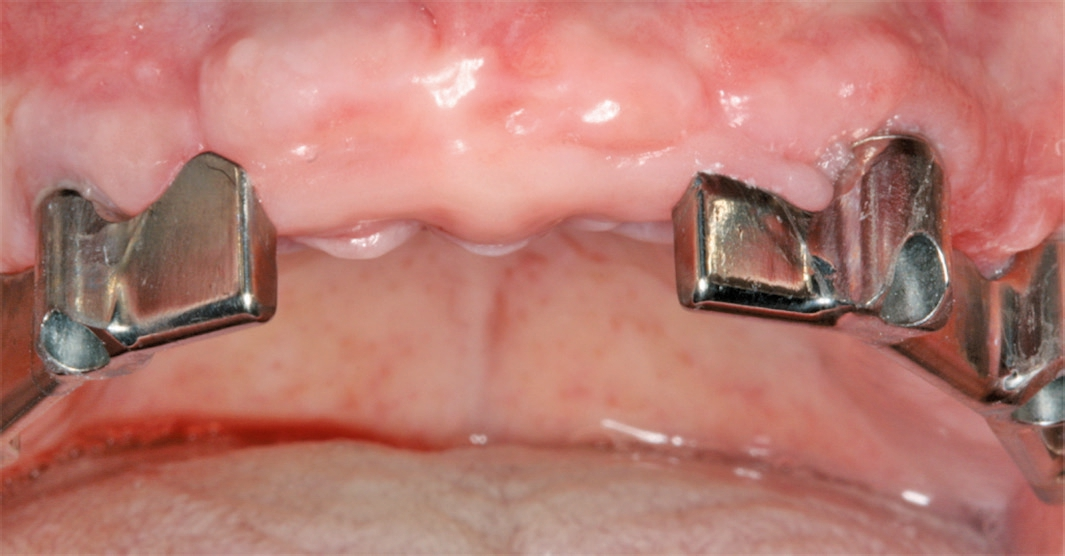 Abb. 8: Stegversorgung im OK mit periimplantärem Knochenverlust regio 013 und 023.