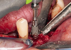 Abb. 8: Implantatinsertion regio 42.