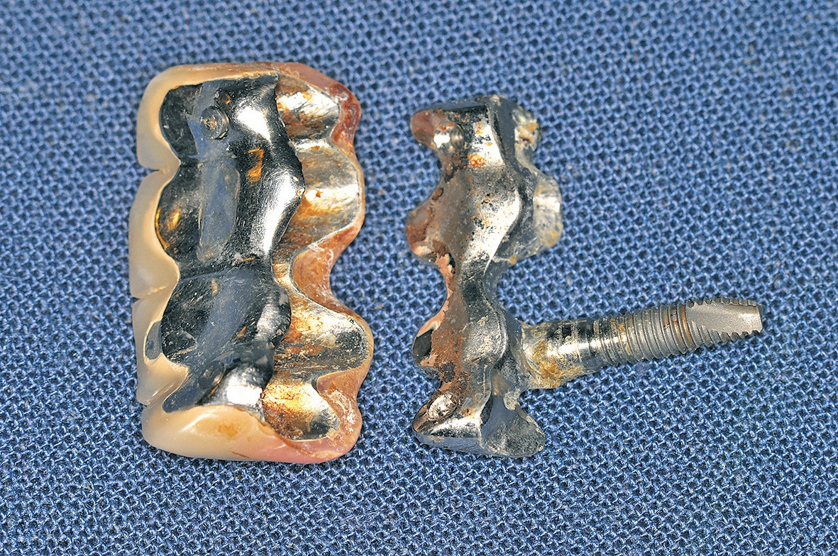 Abb. 9: Plaque und Spaltkorrosion bei einer verschraubten Mesostruktur.