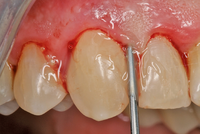 Abb. 8: Der spezielle Aufsatz ermöglicht das leichte Applizieren von Emdogain FL. Anschließend wird der Gingivalsaum vorsichtig gegen den Zahn adaptiert, bis das Zahnfleisch den Zahn umschließt.