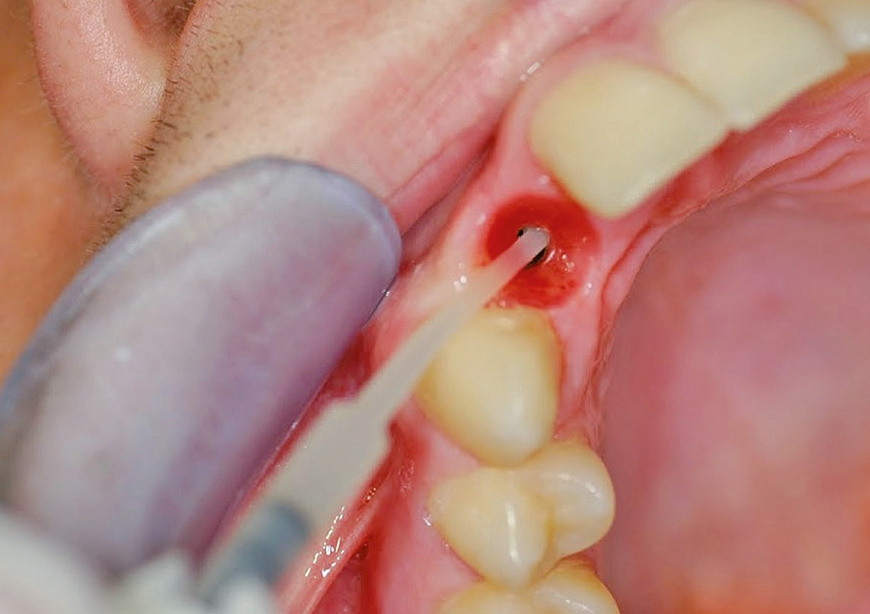 Abb. 8: Anwendung des Materials im Implantat.
