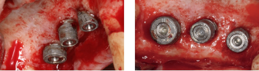 Abb. 11 u. 12: Klinische Darstellung von Phase 3: chirurgische Wiedereröffnung. Die ossären Verhältnisse zeigen sich deutlich stabilisiert und entzündungsfrei. Interimplantär kam es – insbesondere zwischen 14 und 15 – zu einer knöchernen Konsolidierung mit geringgradiger Defektauffüllung. Es wurde eine GBR-Maßnahme mittels titanverstärkter ePTFE-Membran (NeoGen) vorgenommen.