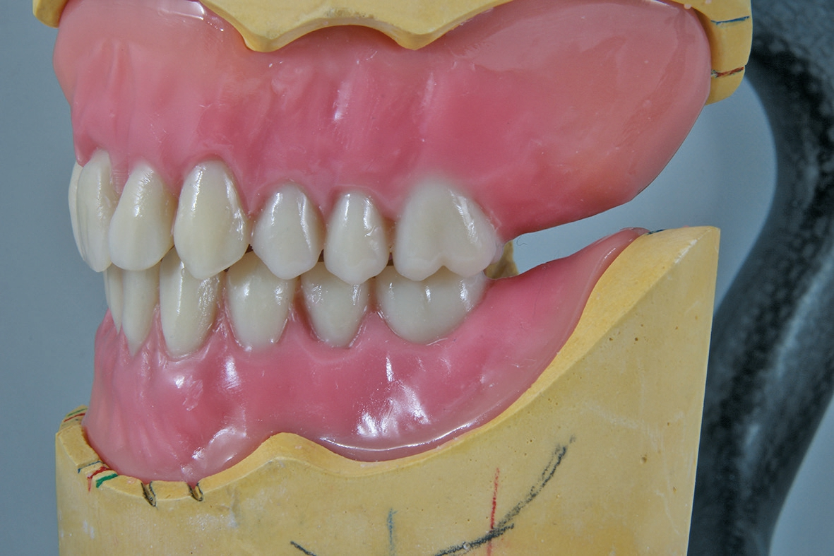 Abb. 8: Seitenzahnaufstellung.