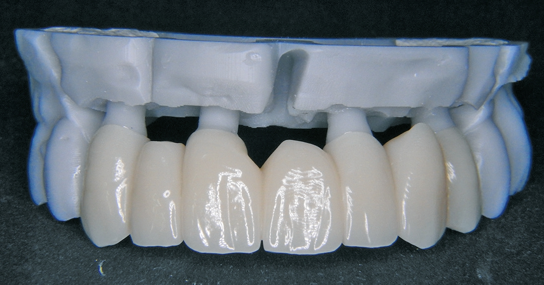 Abb. 8a: Passung des Provisoriums.