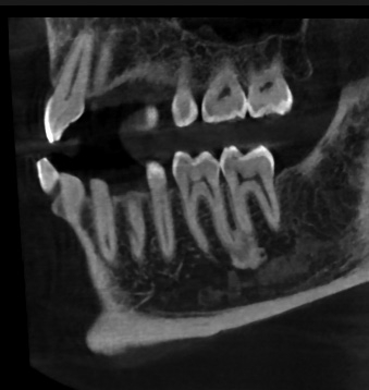 DVT zur diagnostischen Abklärung einer Exostose. Die raumfordernde Wucherung des Odontoms in regio 36, 37 apikal ist gut zu erkennen.