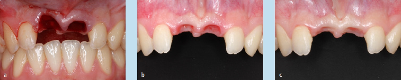 Abb. 6a–c: Sekundärer Zahnverlust nach Frontzahntrauma und intraalveoläre Regeneration mit Vertikalisierung des Knochens und Weichgewebes nach 6 und 12 Wochen.