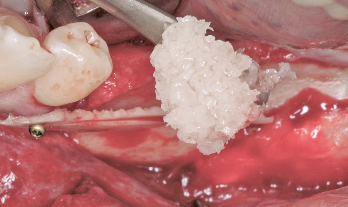 Abb. 9: Auffüllen des Spaltes mit vitalen Knochenspänen.