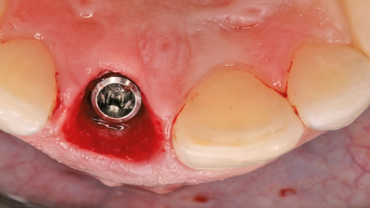 Abb. 7: Nach palatinal versetzte Implantatposition.