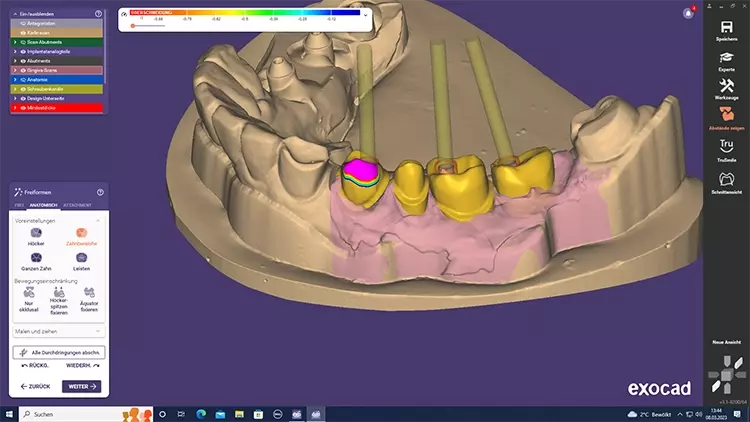 Abb. 8b: Designen des endgültigen Zahnersatzgerüstes digitalen Workflow.