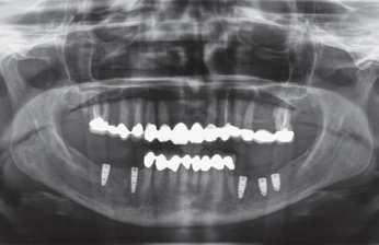 Abb. 9: Die Kontrolle der Implantatposition per OPG.