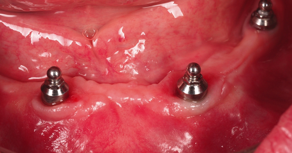 Abb. 10: Relativ parallele Positionierung der Implantate mit geringen Winkelabweichungen.