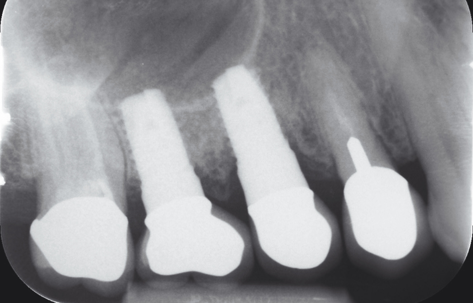 Abb. 5a: Zahnfilm regio 16, 15 zur Darstellung einer Periimplantitis.
