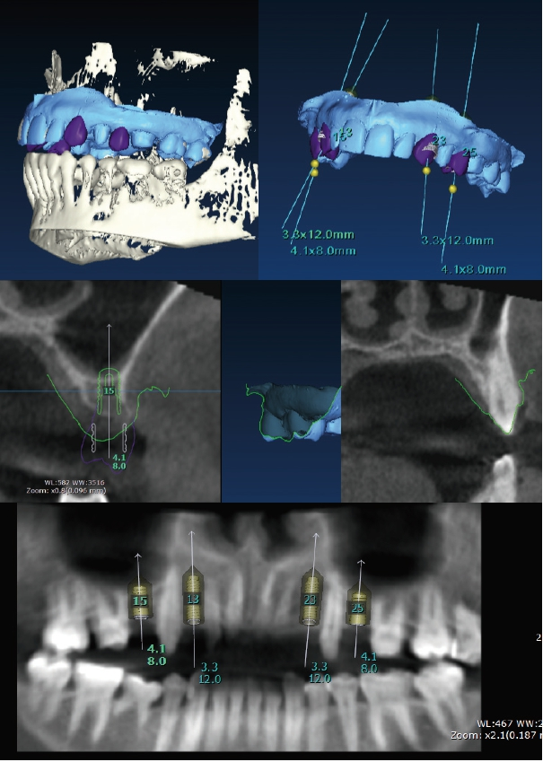 Abb. 7: Digitale Implantatplanung mittels In2Guide (OnDemand3D Software von KaVo) zur Herstellung einer Navigationsschablone. Aufnahme erfolgte im Low-Dose-Modus (KaVo OP300 Maxio FOV Ø 15 x 8 cm). Virtuelles Oberkiefermodell (grüne Linie) inkl. Wax-up (lila Zähne/Linien) mit den DICOM-Daten gematched.