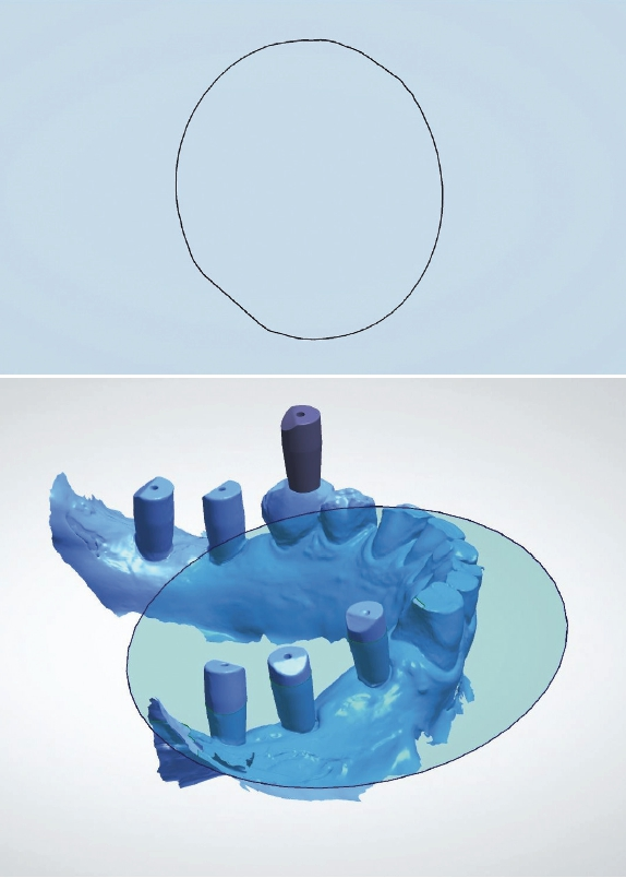 Abb. 9a u. b: Der Scanbody wurde aufgrund der runden Geometrie falsch vom Scanner erfasst.