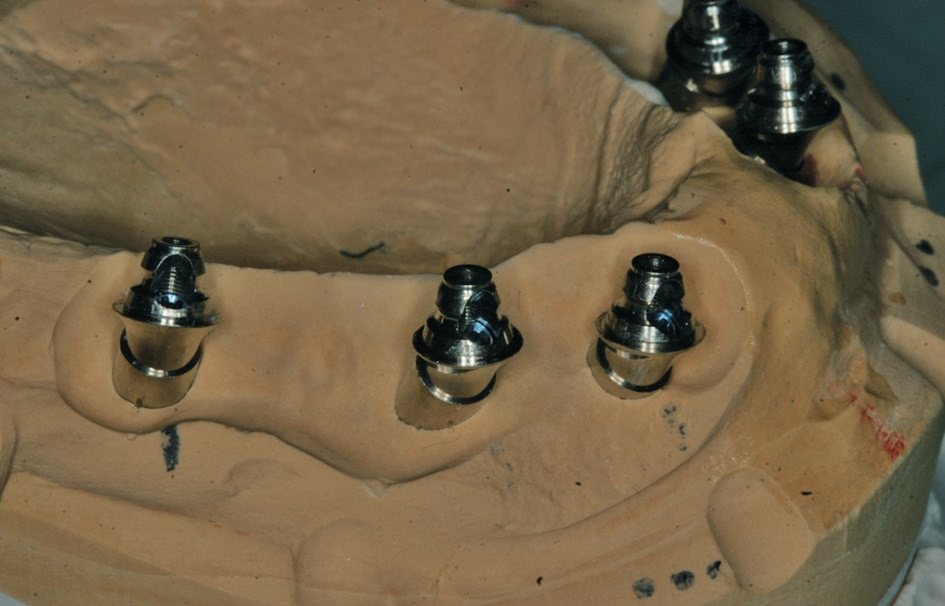 Abb. 9: Auswahl der definitiven Abutments (17° Fast & Fixed-Abutments, bredent medical, Senden).