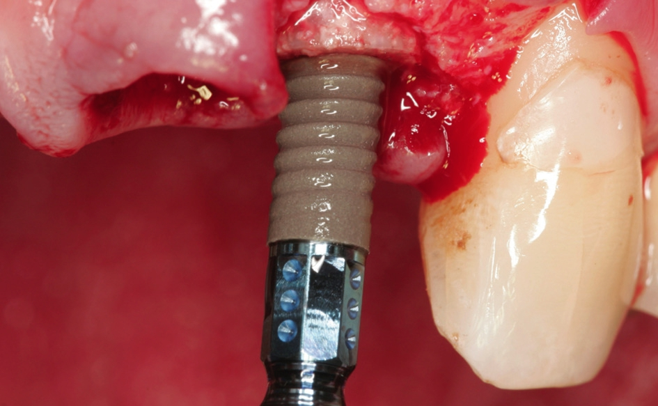 Abb. 8: Implantation Straumann BLT Implantat ø 3,3 mm.
