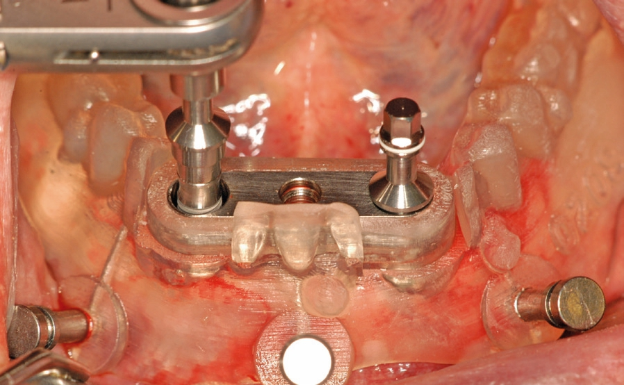 Abb. 9: Die Insertion der Implantate erfolgt ebenfalls durch die Schablone bis zum Anschlag der Einbringpfosten.
