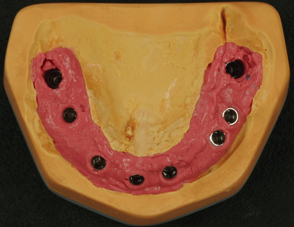 Abb. 9: Meistermodell mit Gingivamaske aus Silikon.