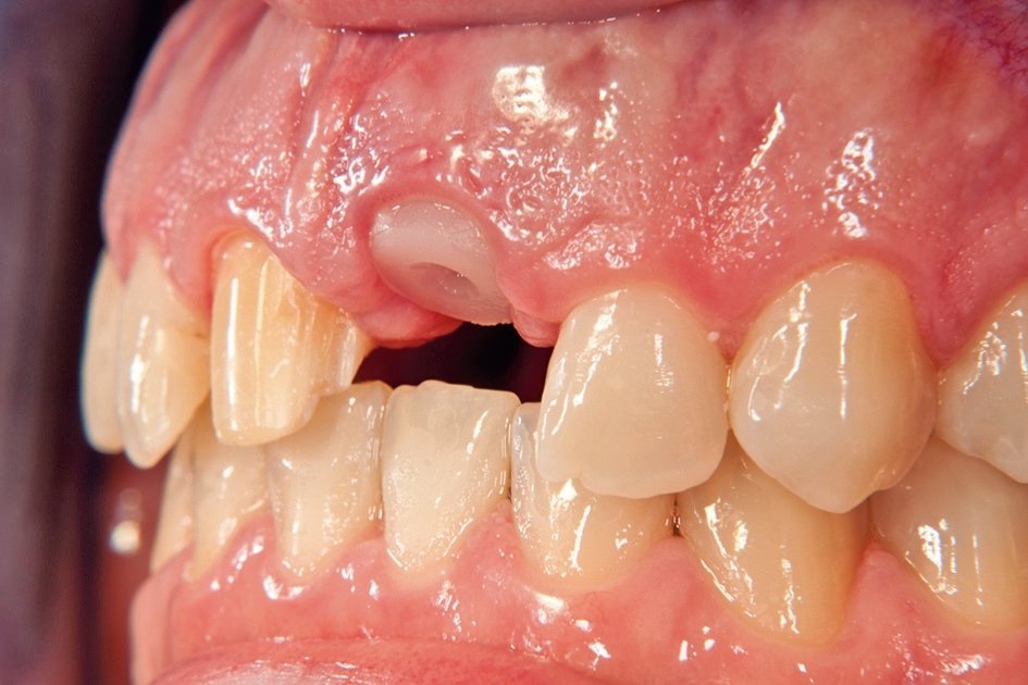 Abb. 9: Gingivaformer zur Ausformung des Zahnfleisches.