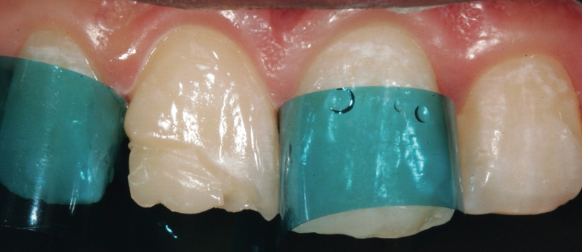 Abb. 9: Aufmodellierter Dentinkern in der Farbe D2.