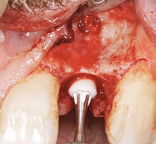 Abb. 9: Um das Implantat gewebeschonend einzubringen, wurde das CERALOG Hexalobe Implantat manuell inseriert und die Implantatschulter 1 mm suprakrestal platziert.