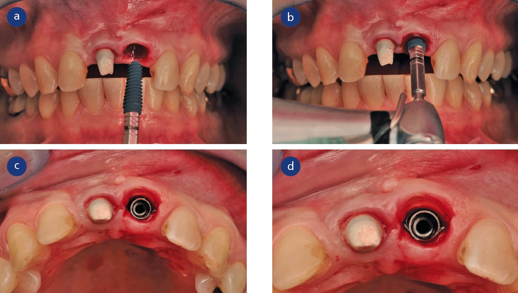 Abb. 9: Implantatinserierung MegaGen@ AnyRidge@ in 21.