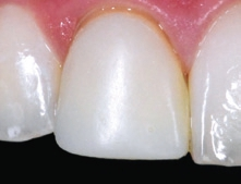 Abb. 9: Das mit G-ænial Universal Flo eingesetzte Provisorium.