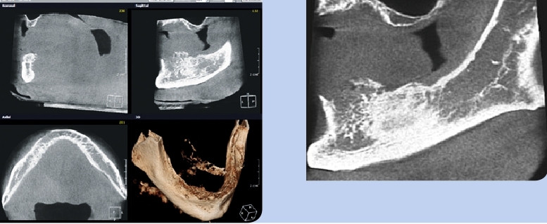 Abb. 13 u. 14: MPR, sagittale Ansicht DVT, ROI.