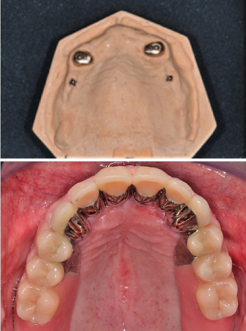 Abb. 9a u. b: Kombiniert festsitzend-abnehmbare gaumenfreie Versorgung auf zwei endodontisch behandelten Zähnen und zwei Implantaten, nach den Gestaltungsprinzipien der Periooverdenture nach Palla.