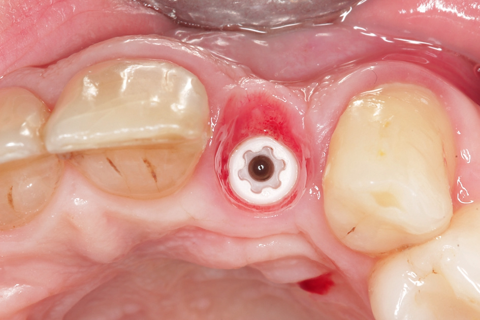 Abb. 24: Das individuell ausgeformte Weichgewebsprofil vor der definitiven Insertion der Implantatkrone.