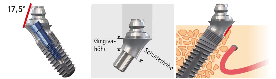 Abb. 11 a bis c: Prinzip der angulierten Aufbauten mit einem 17,5° Außenkonus zum Divergenzausgleich und isokrestaler Positionierung der Implantatschulter.