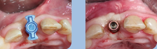 Abb. 10 u. 11: Geschlossene Abformung mit dem SKY esthetic Abformabutment.