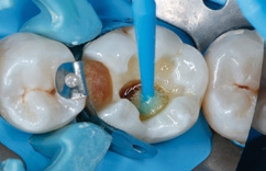 Abb. 9: Applikation des Haftvermittlers Futurabond M+ mit einem Minibürstchen auf Schmelz und Dentin.